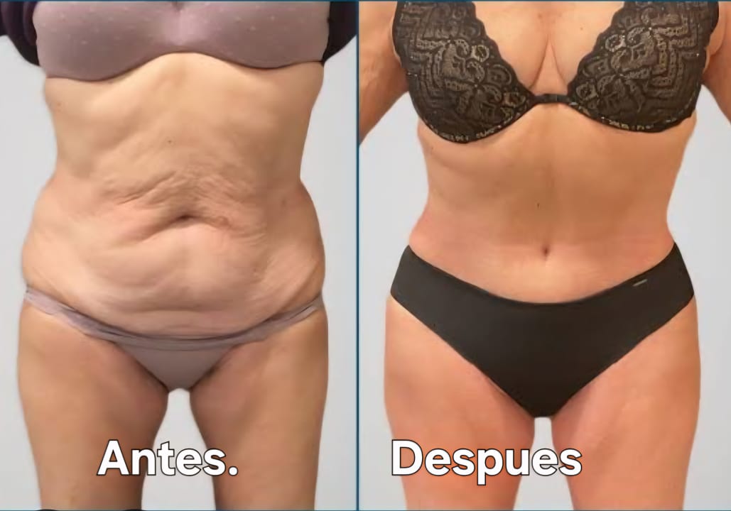 Resultado Miniabdominoplastia 2